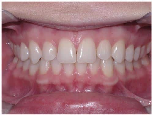 Online Smile Assessment Frontal Intraoral Photo