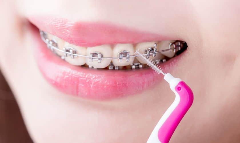 How do Orthodontists Take off Braces?